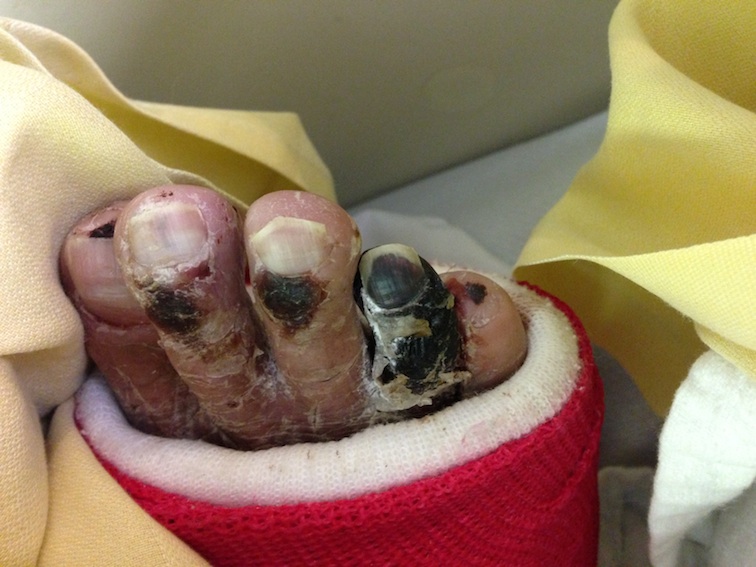 Toe gangrene